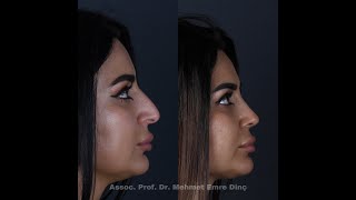 👉Natural amp Attractive Closed Preservation Rhinoplasty result [upl. by Latrell218]