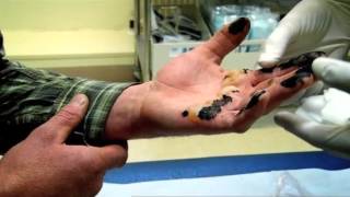 Hand Burnt in Tar  Part 1  Bizarre ER [upl. by Hennahane647]