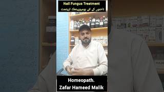 drzafarhameedmalik nails fungus fungustreatment nail homeopathy homeopathic trending [upl. by Gersham]