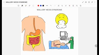 MALLORY WEISS SYNDROME [upl. by Rojas]