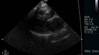 Regional Wall Motion Abnormalities [upl. by Sallad196]