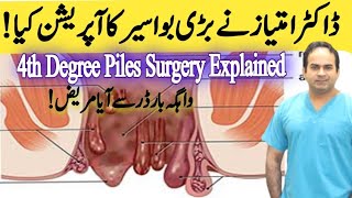 Operation of 4th Degree Piles  Haemorrhoidectomy of very big Piles  Surgeon Dr Imtiaz Hussain [upl. by Arema206]