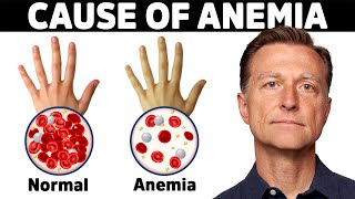 The Hidden Cause of Anemia Youve Never Heard About [upl. by Solitta]