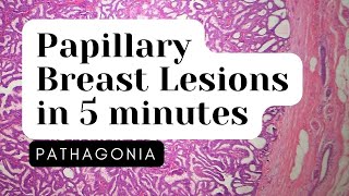 Papillary Neoplasms of Breast 5 Minute Overview pathagonia [upl. by Alyal792]