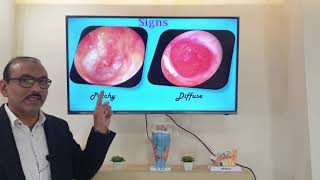 Granular myringitis English Patient teaching programme [upl. by Ydal734]