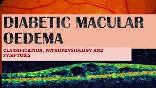 DIABETIC MACULAR EDEMA made incredibly easy [upl. by Ellenej441]