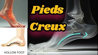 Le pied creux soulager traitement par des Semelles orthopédiques Solutions exercices Kinésithérapie [upl. by Eladnor684]