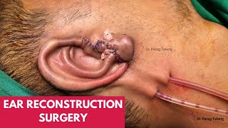 Microtia reconstruction by Dr Parag Telang [upl. by Vanny348]