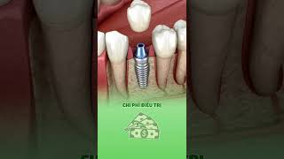 IMPLANT CÓ NHƯỢC ĐIỂM GÌ [upl. by Assilim]