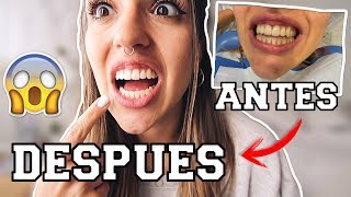 🔥 MI EXPERIENCIA CON EL BLANQUEAMIENTO DENTAL 😰 ¿ME DOLIO ¿PRECIO [upl. by Noyad434]