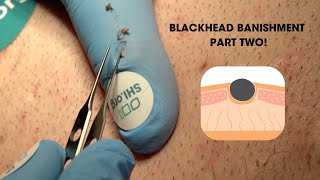 Blackhead Banishment Part Two Super Satisfying Blackhead Squeeze [upl. by Ragde205]