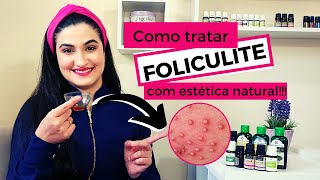 Como tratar FOLICULITE com estética natural [upl. by Shulem362]