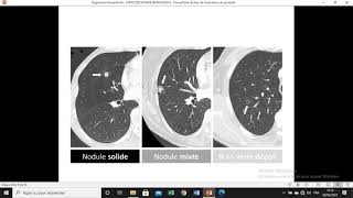 cours pneumologie  opacités et masses intra pulmonaires [upl. by Rinee]