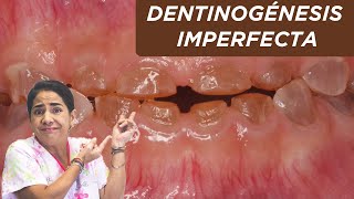 Dentinogénesis imperfecta ¿qué es ¿por qué sucede [upl. by Pier]