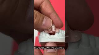 REMOVABLE PARTIAL DENTURE dentist [upl. by Aikar]