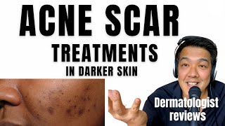 ACNE SCAR TREATMENTS  In Ethnic Skin [upl. by Sirk]