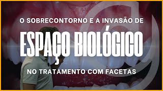 O sobrecontorno e a invasão de espaço biológico no tratamento com facetas [upl. by Phipps]