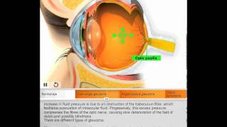 Glaucoma surgery by Quantel Medical [upl. by Airetnuhs]