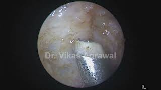 Boundaries of adenoids defined in 6 yr child [upl. by Disharoon]