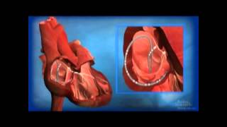 Ablation for AV Node Reentrant Tachycardia AVNRT [upl. by Akiam]