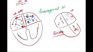 Atrial Fibrillation  Pathophysiology and Clinical [upl. by Durkin37]