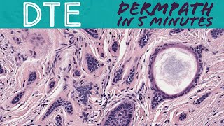 Desmoplastic Trichoepithelioma benign mimic of skin cancer BCC MAC Dermpath in 5 Minutes [upl. by Alejoa]