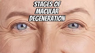 Stages of Macular Degeneration Patient Education Series maculardegeneration [upl. by Leann110]