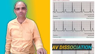 AV DISASSOCIATION IN HEART DISEASE BY DRSUMIT TYAGISUMITMEDICALDISPENSARY1 [upl. by Byron12]