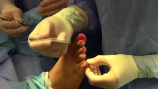 Hammer Toe 5th Digit Surgery  Dr Nagler  Spanish [upl. by Hailey]