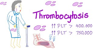 Thrombocytosis Primary and Secondary  Why Is My Platelet Count High  Hematology [upl. by Launce]