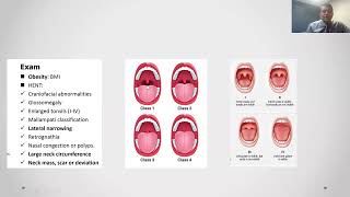 Obstructive Sleep Apnea  Diagnosis and Treatment [upl. by Mckinney811]