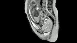 Weltpremiere in Berlin Video einer Geburt im MRT  DER SPIEGEL [upl. by Koffler]
