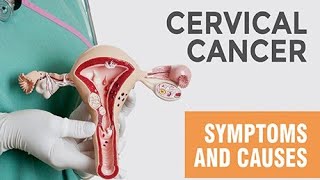 cervical cancer cancer mbbs doctor cervicalcancersymptoms medical medicalstudent [upl. by Secilu]