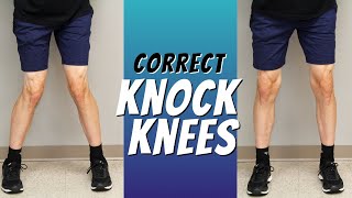 Top 5 Ways to Correct Knock Knees with Exercise Etc [upl. by Deelaw]