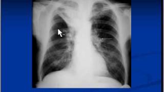 Chest xray interpretation Right upper lobe collapse [upl. by Ennalorac]