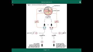 Kallmann Syndrome  متلازمة كولمان [upl. by Luis]