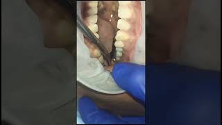 Left upper premolar molar replacement with basal implants and g cam bridge 40 micron clearance test [upl. by Irtemed]