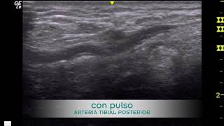 ECOGRAFIA VASCULARIZACIÓN ARTERIA TIBIAL POSTERIOR PIE DIABETICO [upl. by Arimahs]