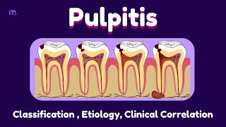 Pulp Pathosis  1  Pulpitis  Etiology  Clinical correlation  Endodontics  Animated explanation [upl. by Welton]