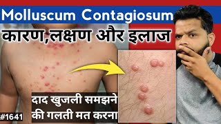 Molluscum Contagiosum Treatment In Hindi  Molluscum Contagiosum Causes And Symptoms [upl. by Rhetta]