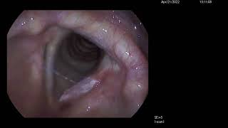 Left Vocal Cord Cancer Surgical Treatment Using CO2 Laser [upl. by Pearline360]