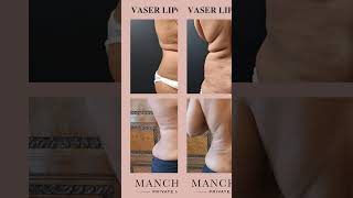 Stunning VASER Liposuction Transformations at Manchester Private Hospital  Advanced Body Contouring [upl. by Uwkuhceki]