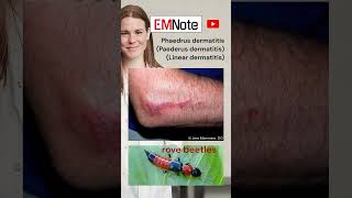 Paederus Linear Dermatitis medical doctor nursing [upl. by Kareem230]