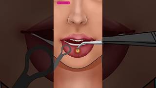 How to Safely Remove Unmanaged Lip Piercing Pus amp Squeeze Out Infection [upl. by Kieran]