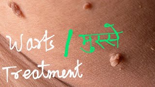 warts  मस्से  permanent treatment [upl. by Notneuq502]