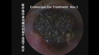 Ear discomfort cerumen block cleaning 20231102 [upl. by Acsehcnarf]