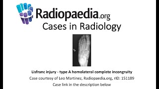 Lisfranc injury  type A homolateral complete incongruity Radiopaediaorg Cases in Radiology [upl. by Ingold]