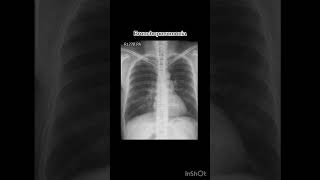 Bronchopneumonia xray radiology röntgen pneumonia [upl. by Aihsercal]