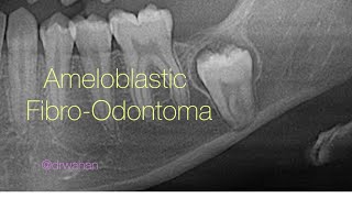 Ameloblastic FibroOdontoma Removal with Molar Extraction [upl. by Cailean576]