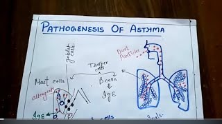 pathogenesis of asthma NGMedicals [upl. by Zucker]